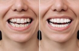 Aligners & Invisalign in Jaipur – Straighten Your Teeth Without Braces